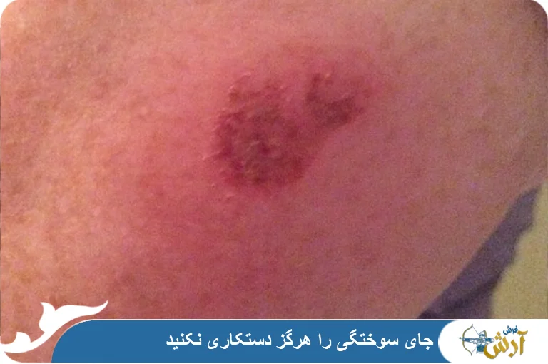 درمان سوختگی پوست بر اثر کشیده شدن روی فرش