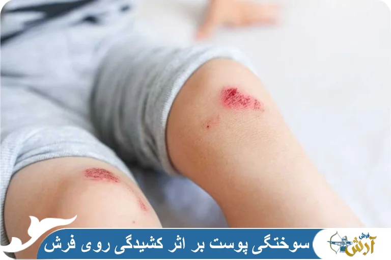 سوختگی پوست بر اثر کشیدگی روی فرش+روش‌های درمان